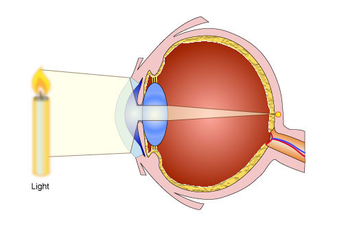 myopia diagram gcse)