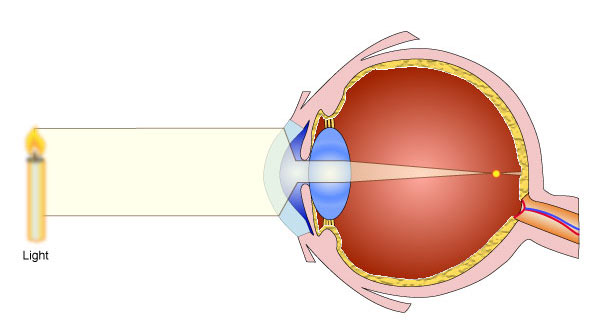 myopia diagram gcse